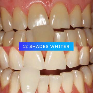 Before & After Professional Teeth Whitening - 12 Shades Lighter