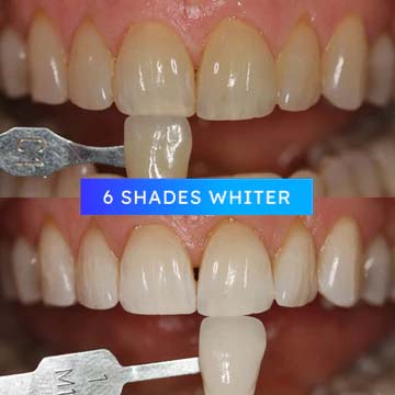 Before & After Professional Teeth Whitening - 6 Shades Lighter