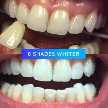 Before & After Professional Teeth Whitening - 8 Shades Lighter