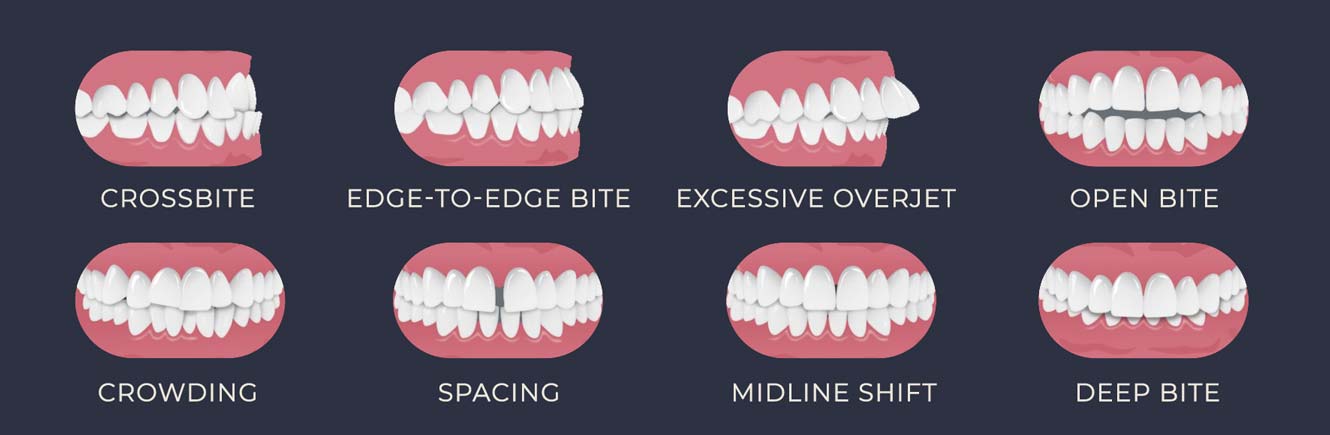 Clear Aligner Fixes by Case Type (Malocclusion)