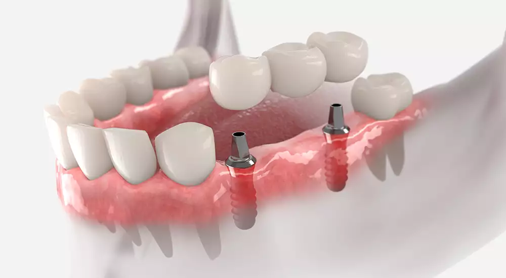 Dental Implant Bridge for Multiple Teeth