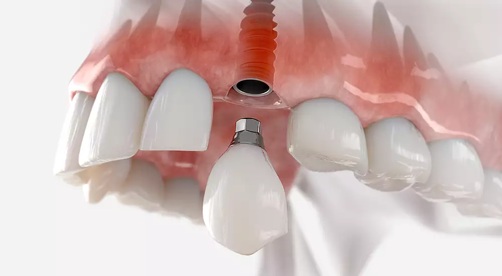 Dental Implant Illustration