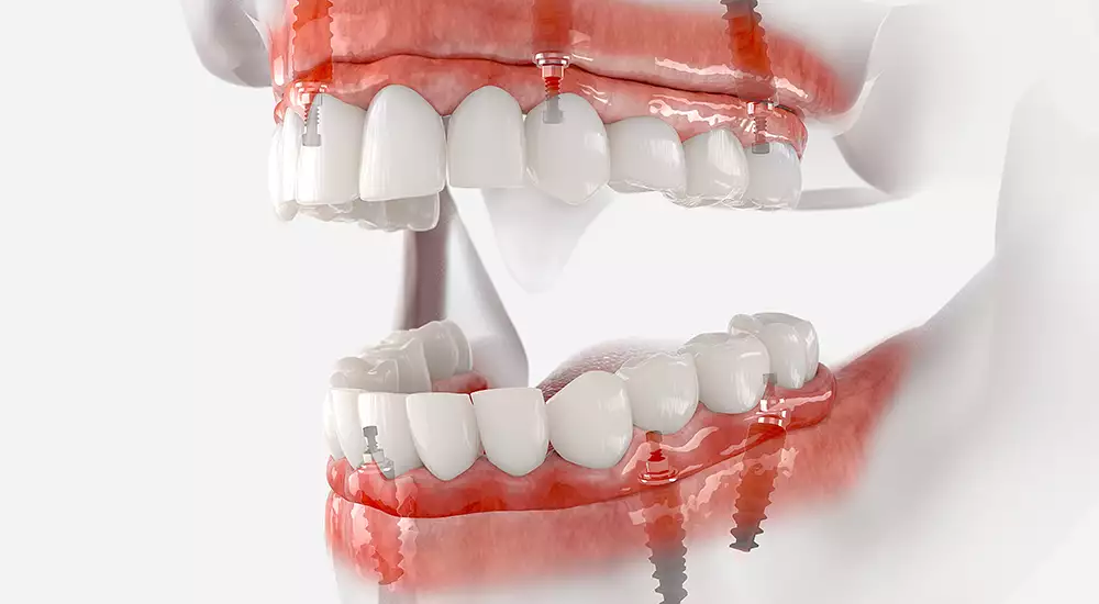Full Mouth Dental Implants for Rejuvenation