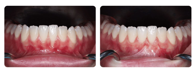 Gum Graft 1