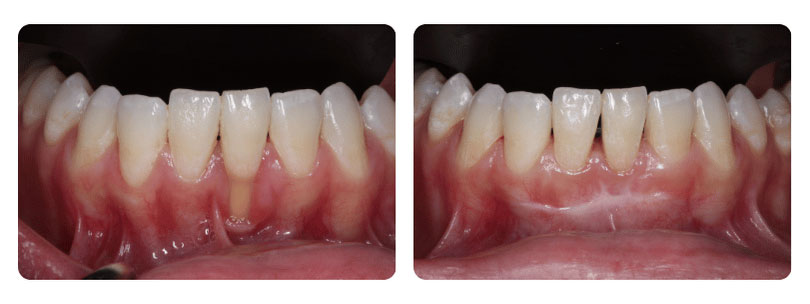Gum Graft 2