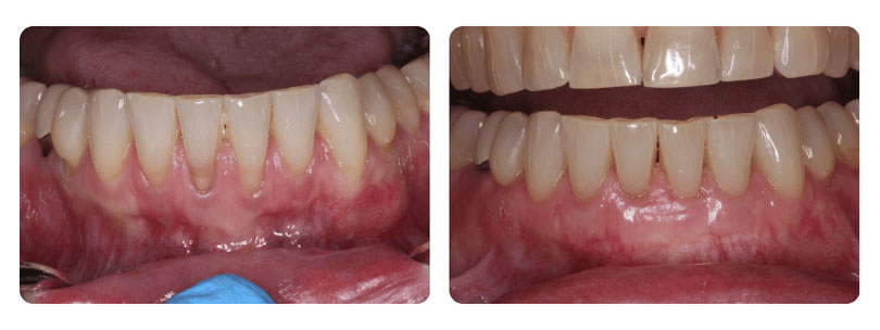 Gum Graft 3