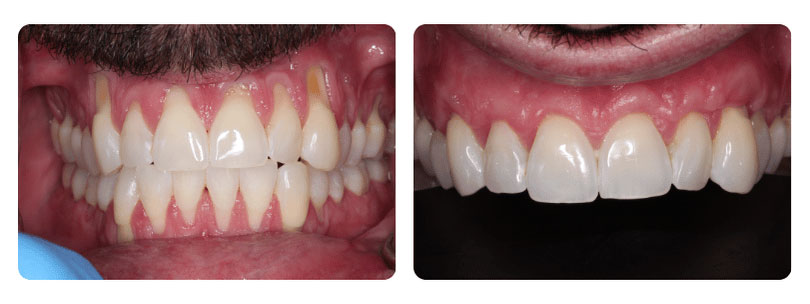 Gum Graft 4