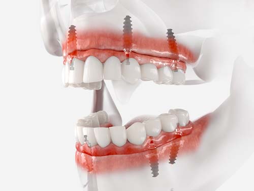 Implant Supported Dentures