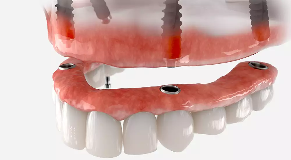 Implant Supported Over Denture