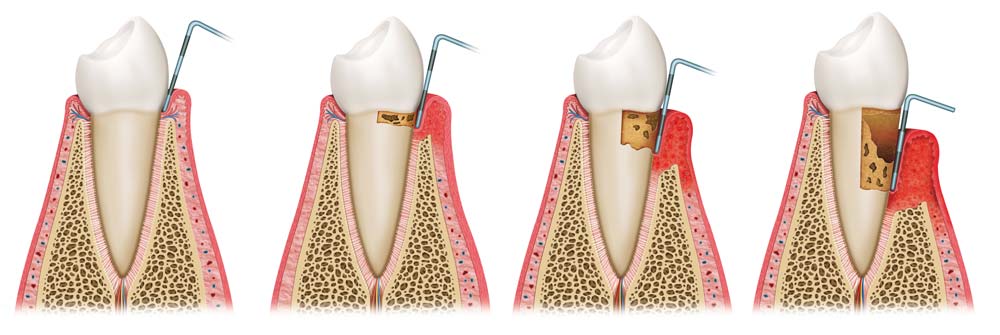 Periodontal Disease Stages