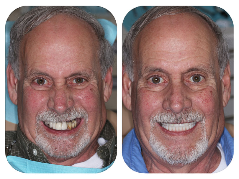 Smile Makeover Patient - Dental Implants